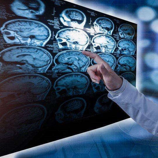 Hipofiz Mikroadenomu